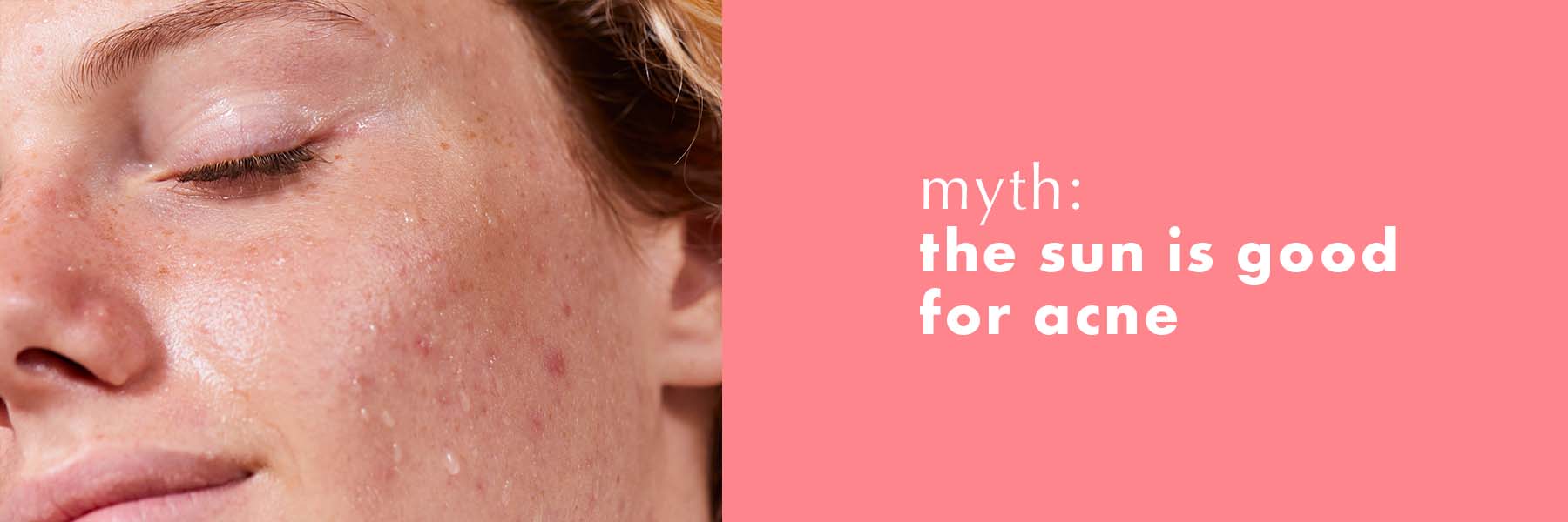 Myth 1: The sun is good for acne
