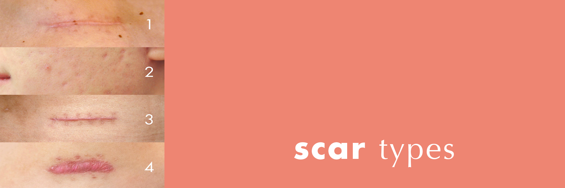 Types of scars