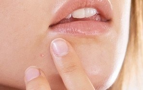 Program njege za kožu sklonu pojavi akne u odrasloj dobi