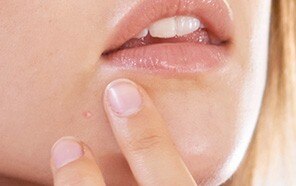 Ritual para la piel con tendencia acnéica de la mujer adulta