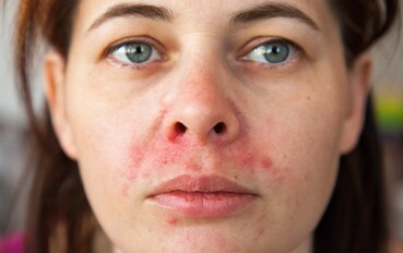 Periorale Dermatitis Bei Uberempfindliche Haut Eau Thermale Avene