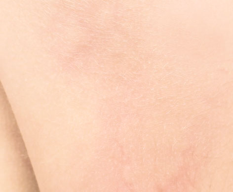 Netolerantna i alergijama sklona koža