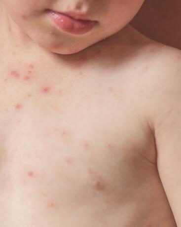 iritatie infectioasa copii