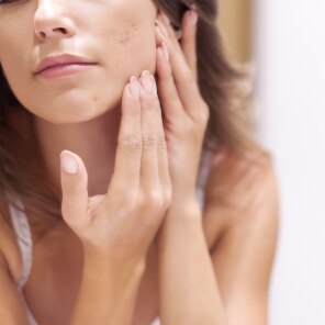 Tot ce trebuie să știi despre acnee