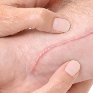 Beneficiile masajului asupra cicatricei 