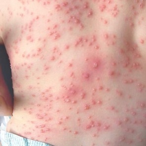 Cum pot fi evitate cicatricile lăsate de varicelă?