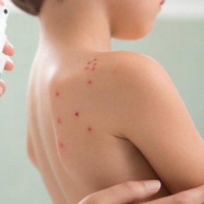 Cum îngrijim pielea cu varicelă